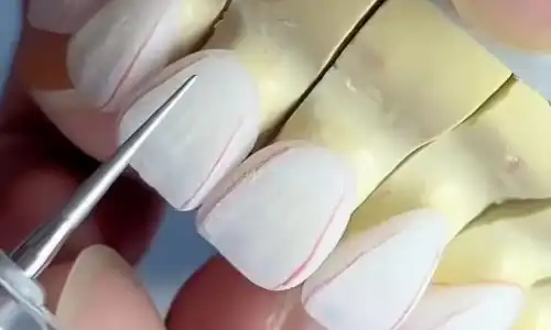How to Improve PFM Crown Fit and Avoid Marginal Discrepancy & High Occlusion